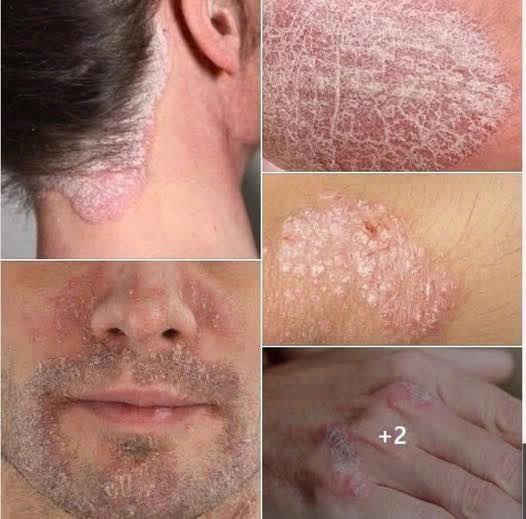 Do you suffer from psoriasis? Discover what’s behind this condition and how to manage it