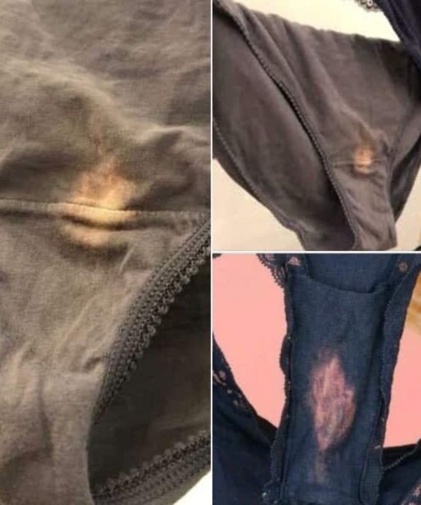 If you find a “bleach” patch on your underwear, here’s what it means