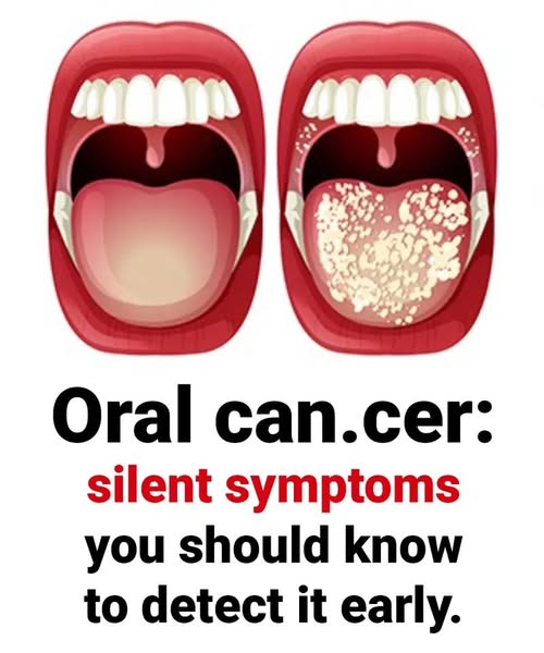 Oral Can.cer: Symptoms You Shouldn’t Ignore.